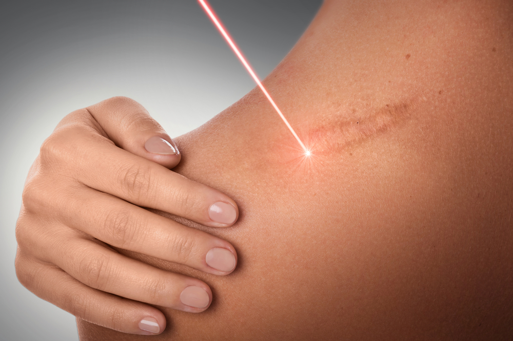 laser para cicatrices